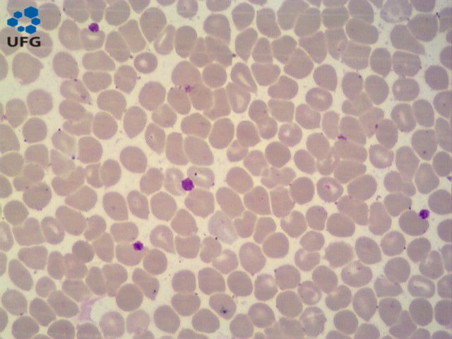 Policitemia vera