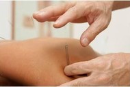 Acupuntura
