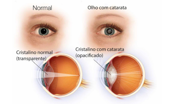 AGOSTO CINZA - OLHO NORMAL X CATARATA