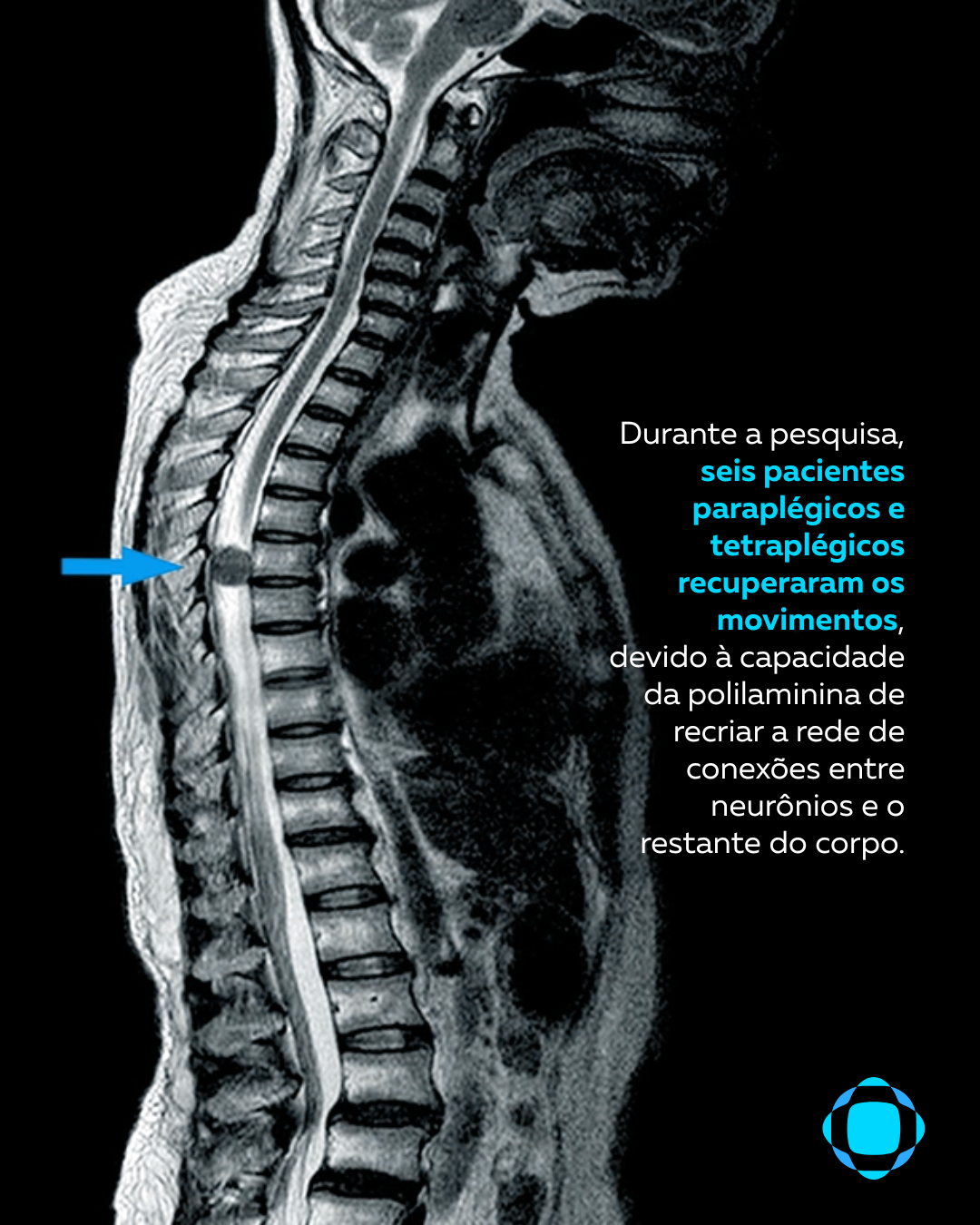 lesao medular - ilustraçao (3)