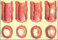 Aterosclerose