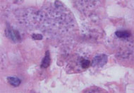 Leishmaniose