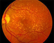 Retina