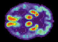 Alzheimer