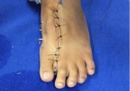 cirurgia pé