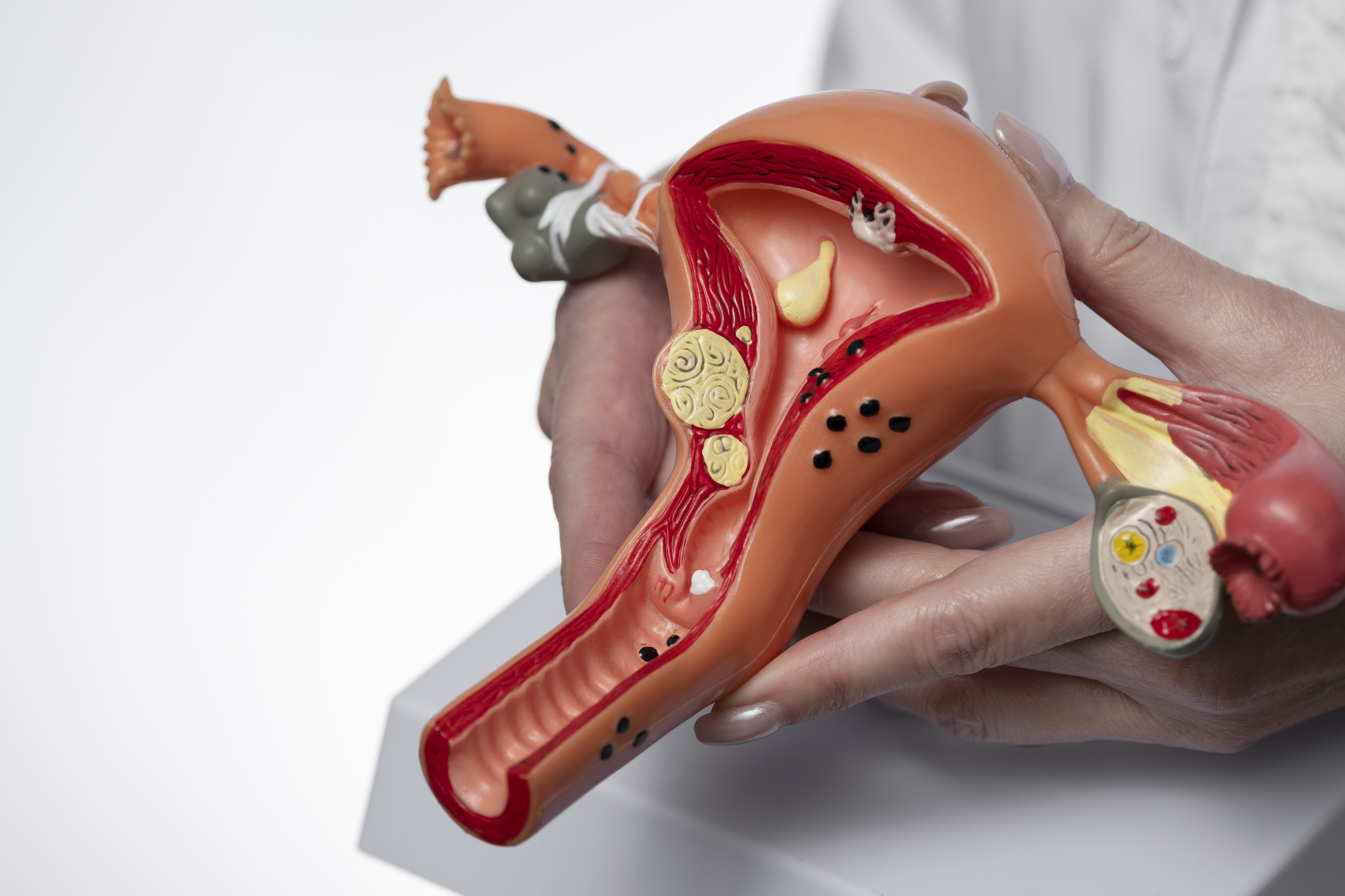 Março Amarelo  A importância de conhecer o que é a endometriose 1