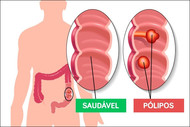 Câncer de Intestino