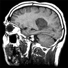 tumor_cerebral
