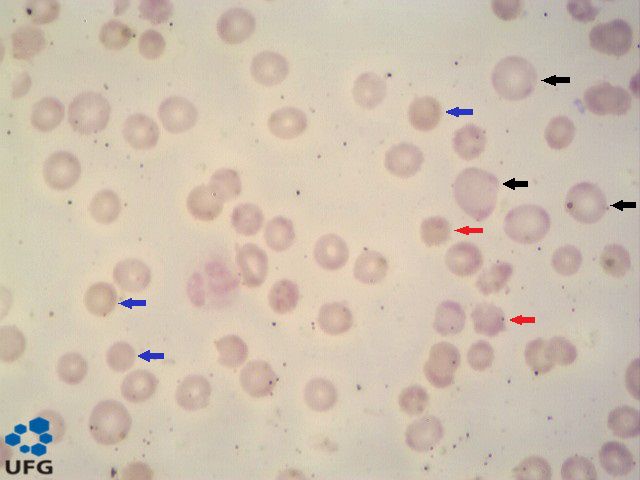 Anisocitose 6
