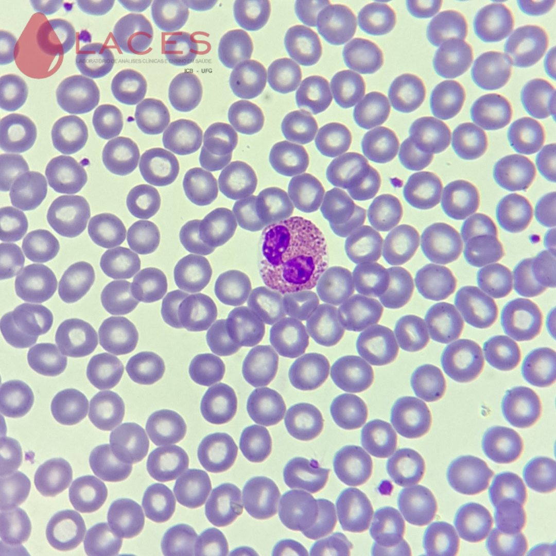 Eosinófilo (formato do núcleo característico bilobulado com grânulos eosinofílicos no citoplasma). Hemácias normocíticas e normocrômicas.