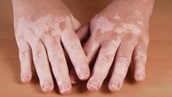 vitiligo